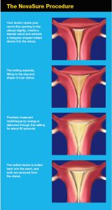 Why I Got NovaSure® Endometrial Ablation - fountainof30.com